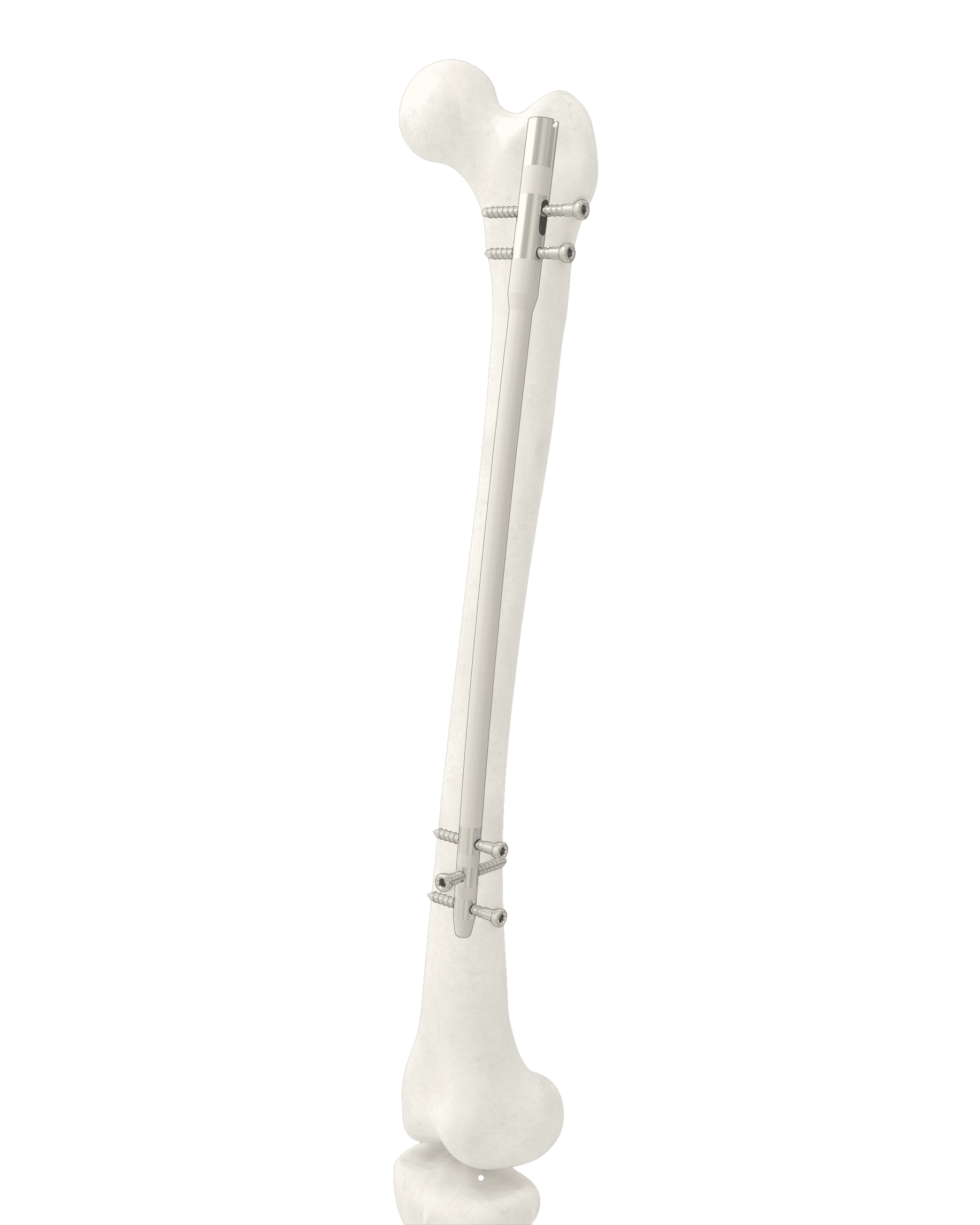 Clous Synicem de Synimed