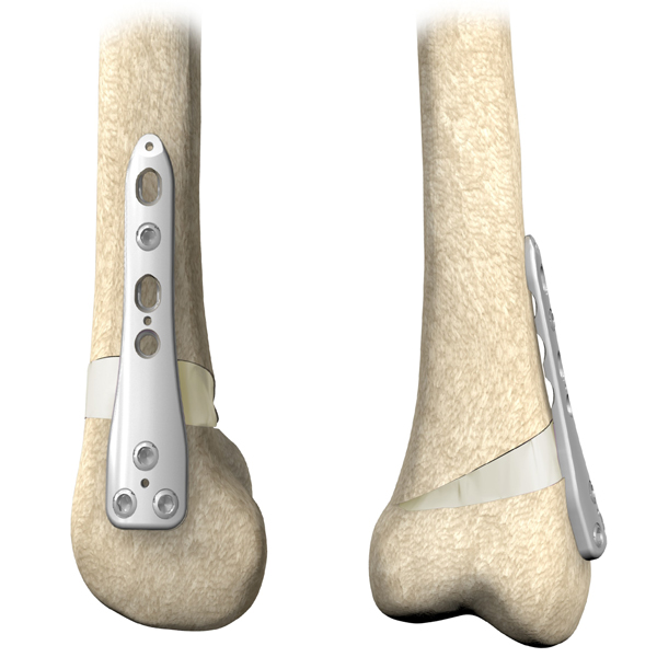 Distal Femoral Osteotomy System