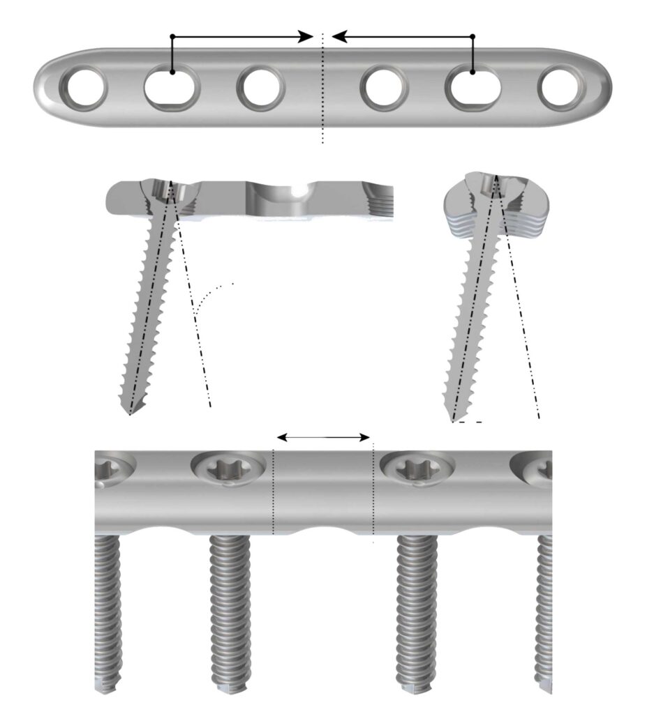 PediFrag™ System