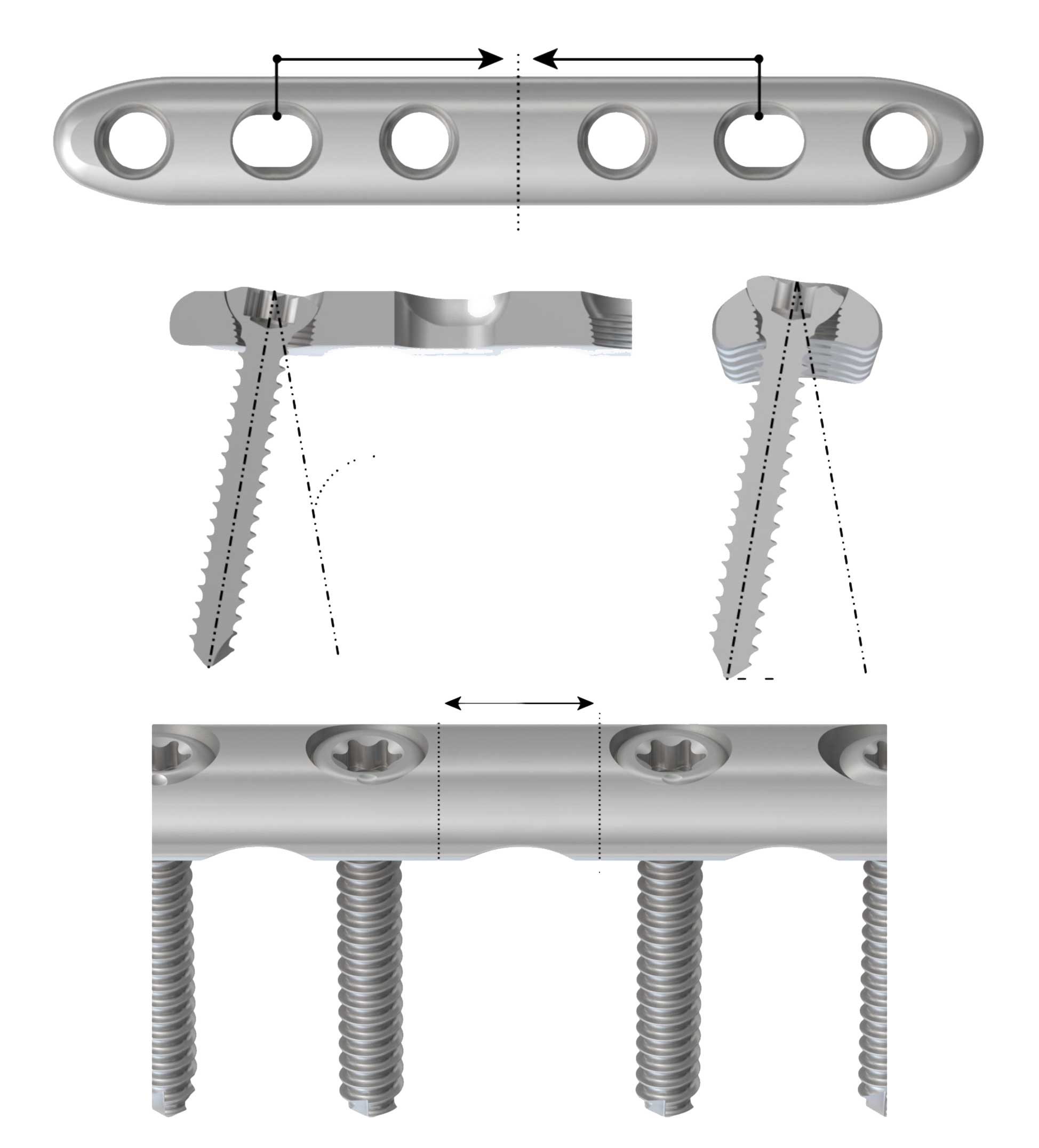 PediFrag™ System