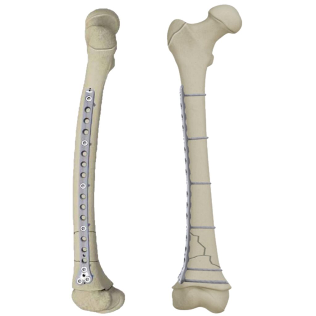 PediLoc® Femur