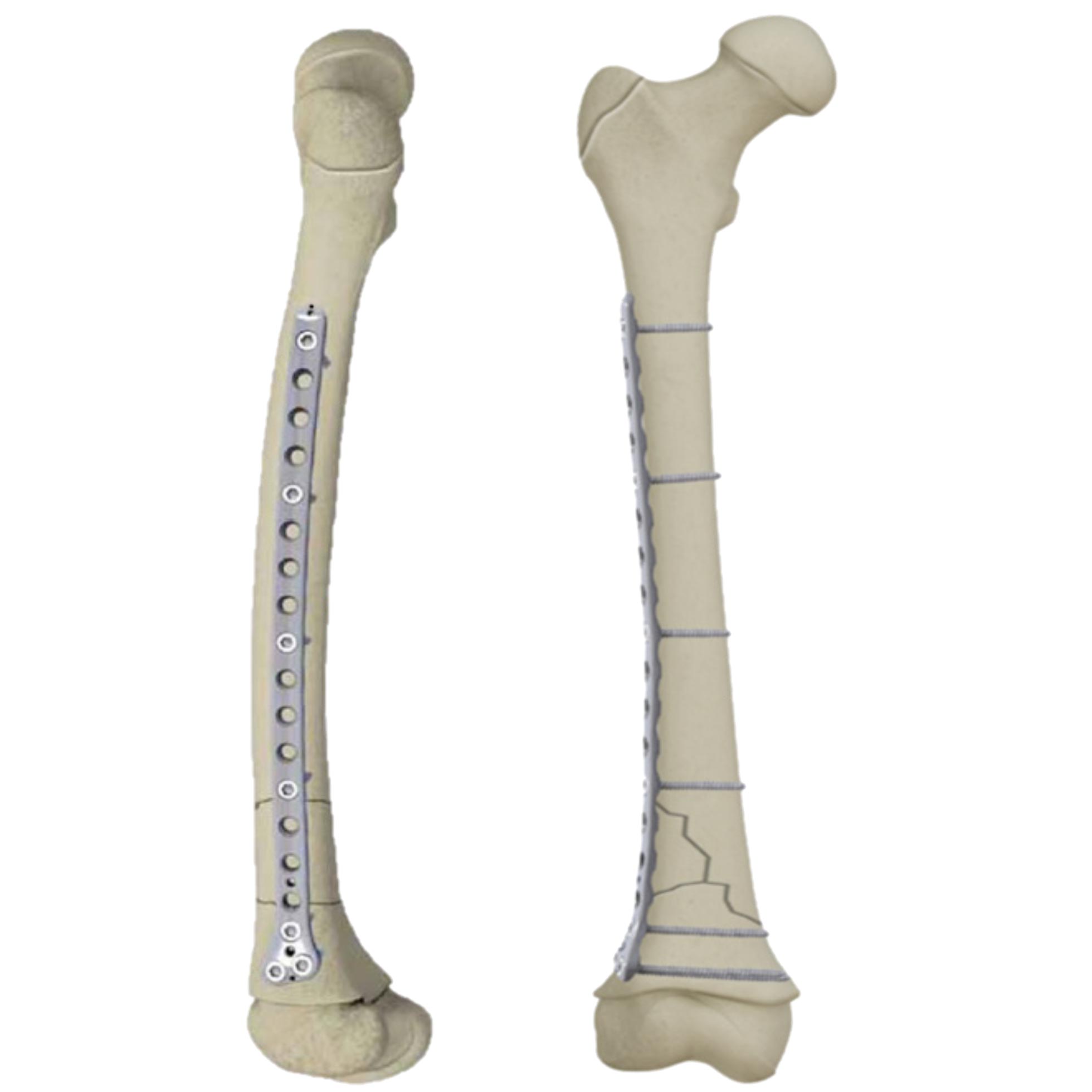 PediLoc® Femur