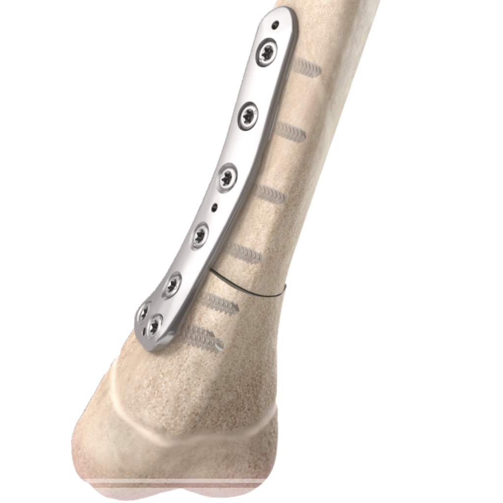 Pediloc Tibia