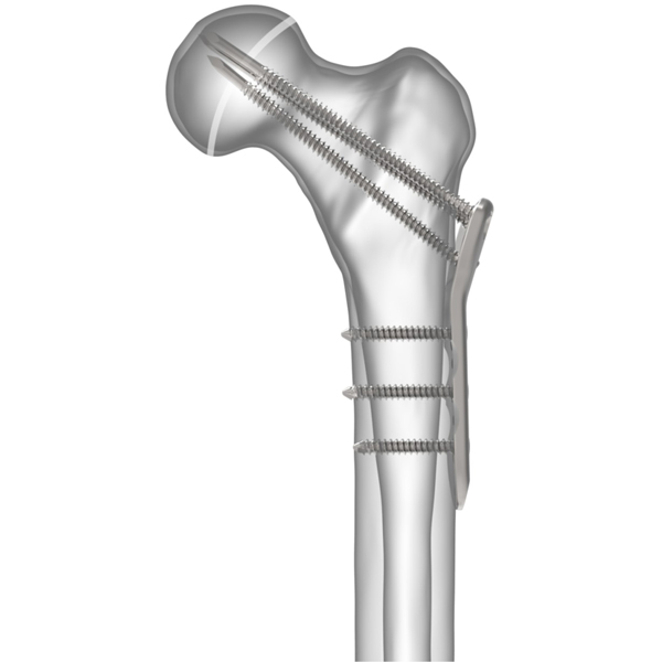 Trans-Physeal Locking Screws Locking Proximal Femur System