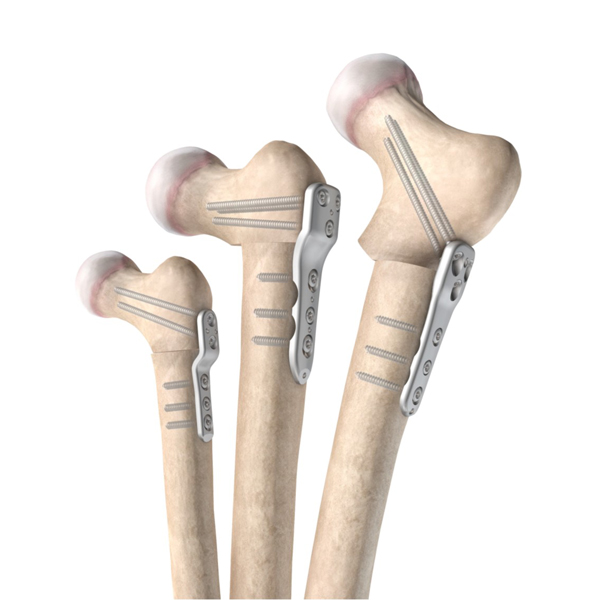 Système de plaque de verrouillage pour fémur proximal PediLoc®